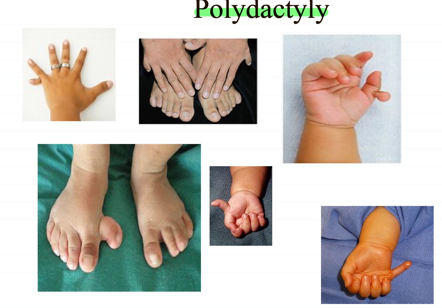 <ul><li><p>when a person is born with more than 5 fingers or (and) toes</p></li></ul><p></p>