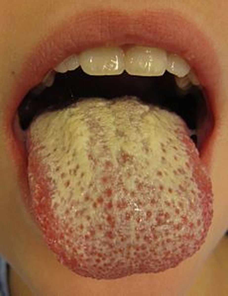 <p>A yeast infection of the mouth or vagina</p>