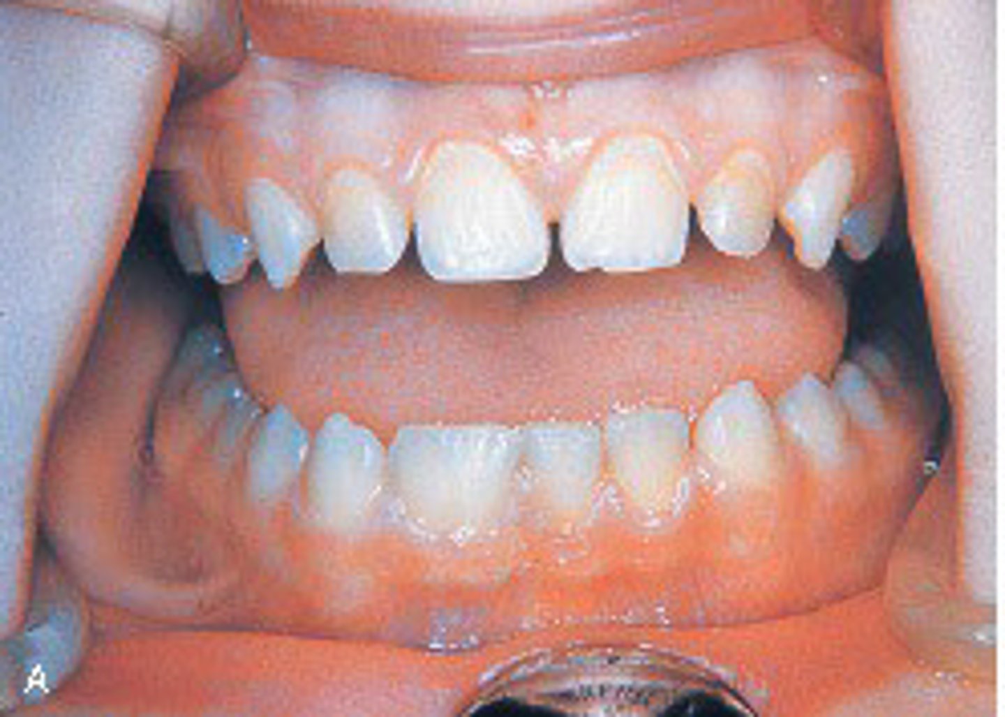 <p>fusion.</p><p>Fusion is the union of two normally separated adjacent tooth germs. Gemination is when a single enamel organ (tooth germ) divides partially. Concrescence occurs when two adjacent teeth are united by cementum. Dilaceration refers to an abnormal curve or angle in the root.</p>