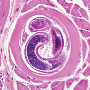 <p>in wide range of hosts, human tissue</p><p>Eosinophila, muscle pain, ocular pain, pneumonia, petechial hemorrhage in conjunctiva and under nail beds</p><p>worldwide</p><p>history of eating undercooked/raw meat</p>