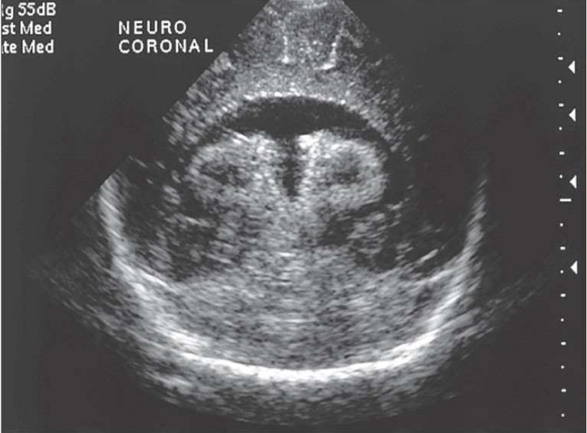 <p>What pathology is being shown?</p>