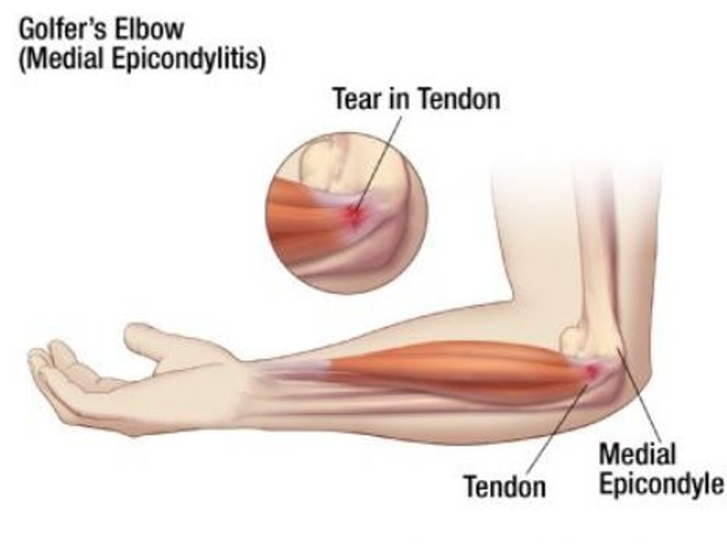 <p>medial distal end of humerus</p>