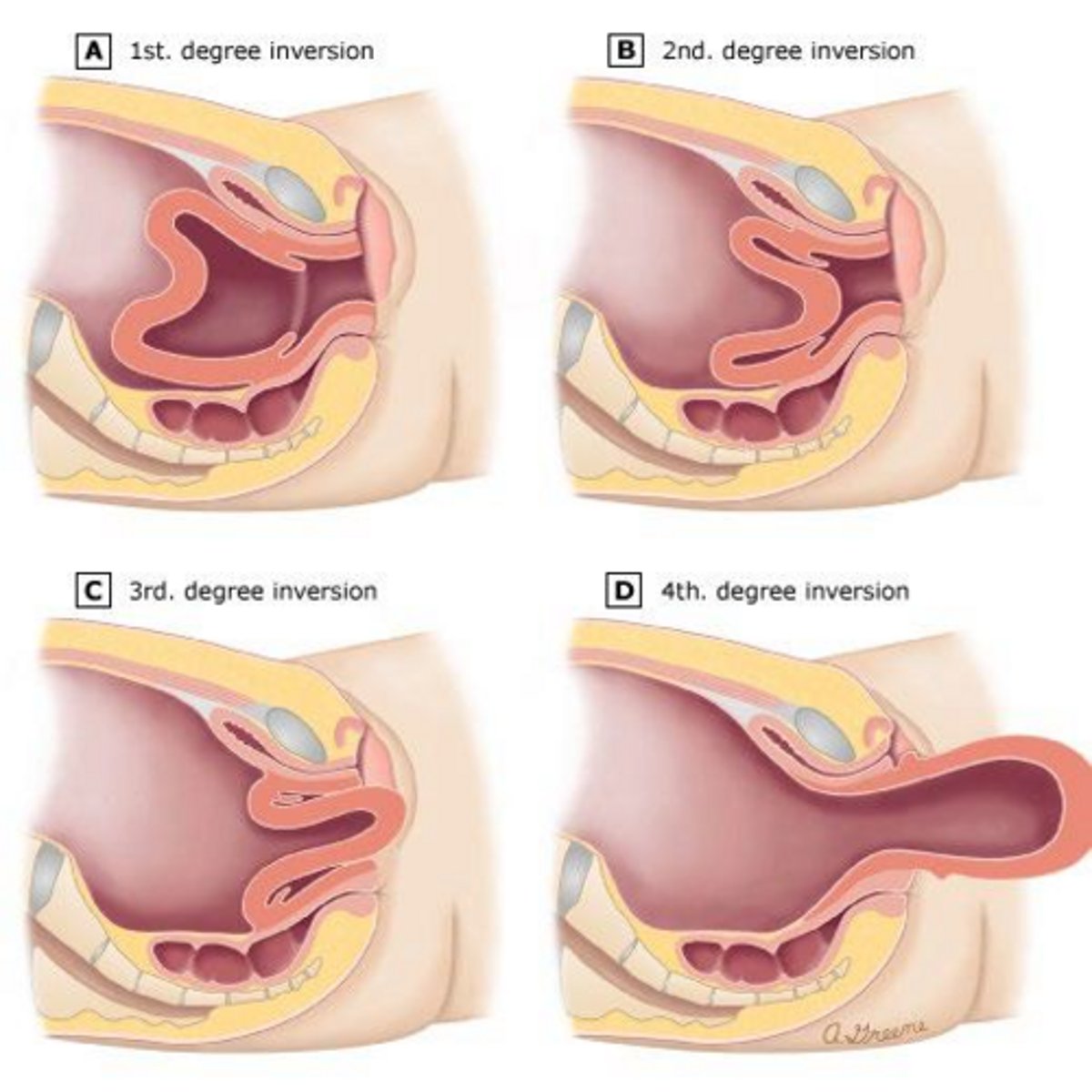 <p>IV fluids and manual replacement of the inverted fundus.</p>