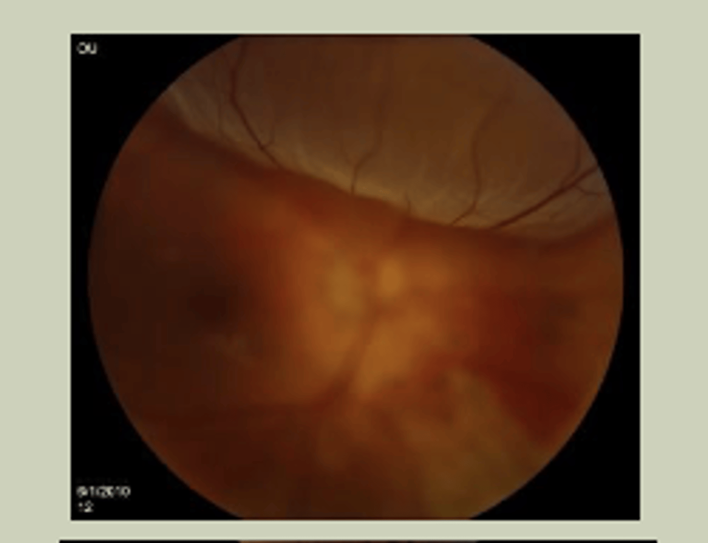 <p>-Sudden, painless loss of vision in one or more quadrants</p><p>-May report a veil in vision, flashes of light</p><p>-Associated with nearsightedness</p><p>-Macula-off visually worse than Macula-on</p><p>-TX: URGENT referral to ECP STAT referral to retinal specialist</p>