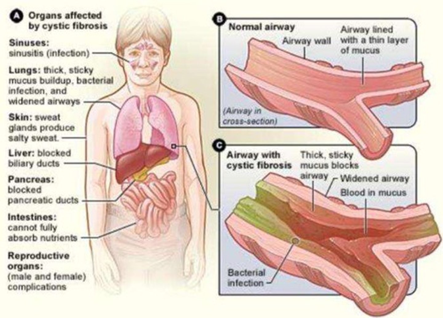 <p>Sinuses: sinusitis; Lungs: thick mucus buildup, bacterial infection; Skin: salty sweat; Liver: blocked biliary ducts; Pancreas: blocked pancreatic ducts; Intestines: nutrient absorption issues; Reproductive organs: complications.</p>