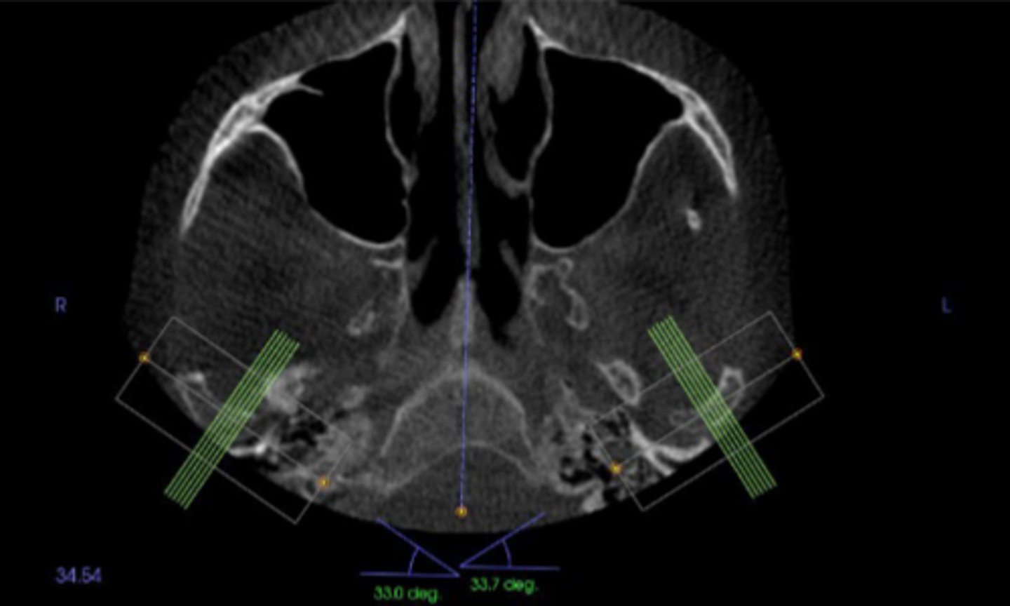 <p>The condylar neck is angled about 15-33° with a sagittal view so that the medial pole of the condyle is located ____________ to the lateral pole.</p>