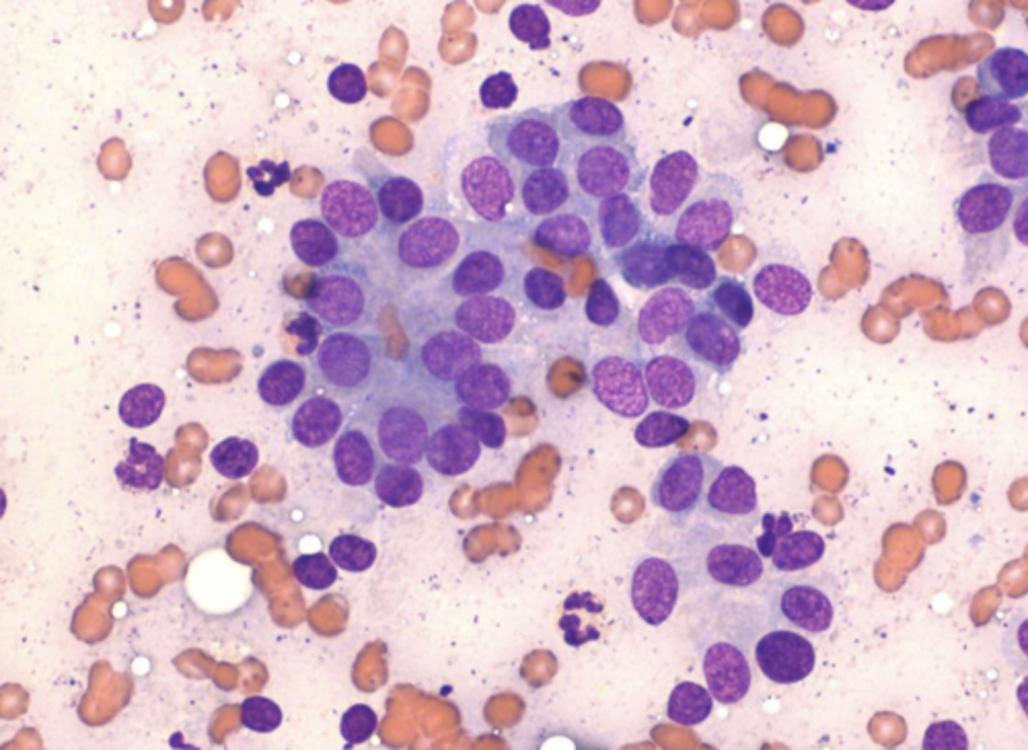 <p>What type of tumor produces this cellular pattern?</p>