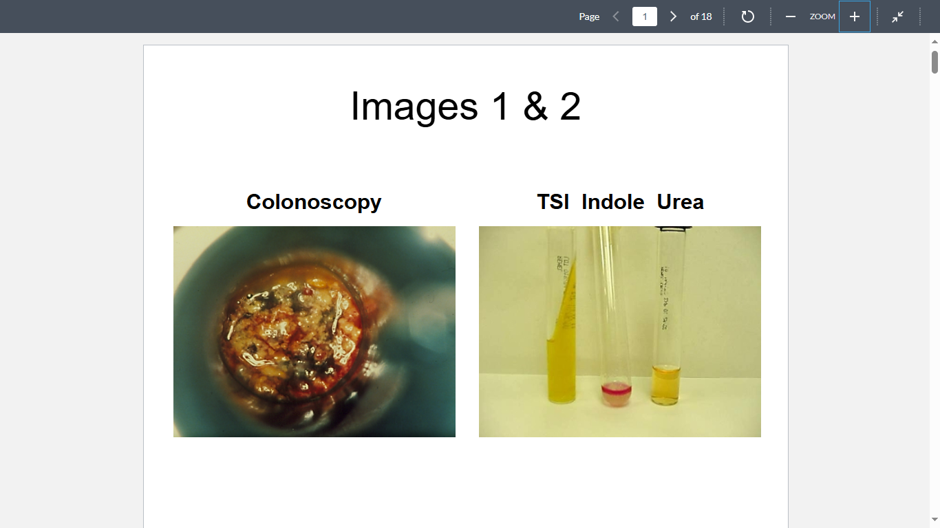 <p>Questions 1-2 A five-year-old girl presents at University Hospital complaining of severe abdominal pain, nausea and vomiting, and frequent bloody diarrhea. The Attending Physician suspects hemolytic uremic syndrome and orders a colonoscopy and microbiological testing (Images 1&2) to confirm the diagnosis.</p><p></p><p>What organism is the most likely cause?</p>