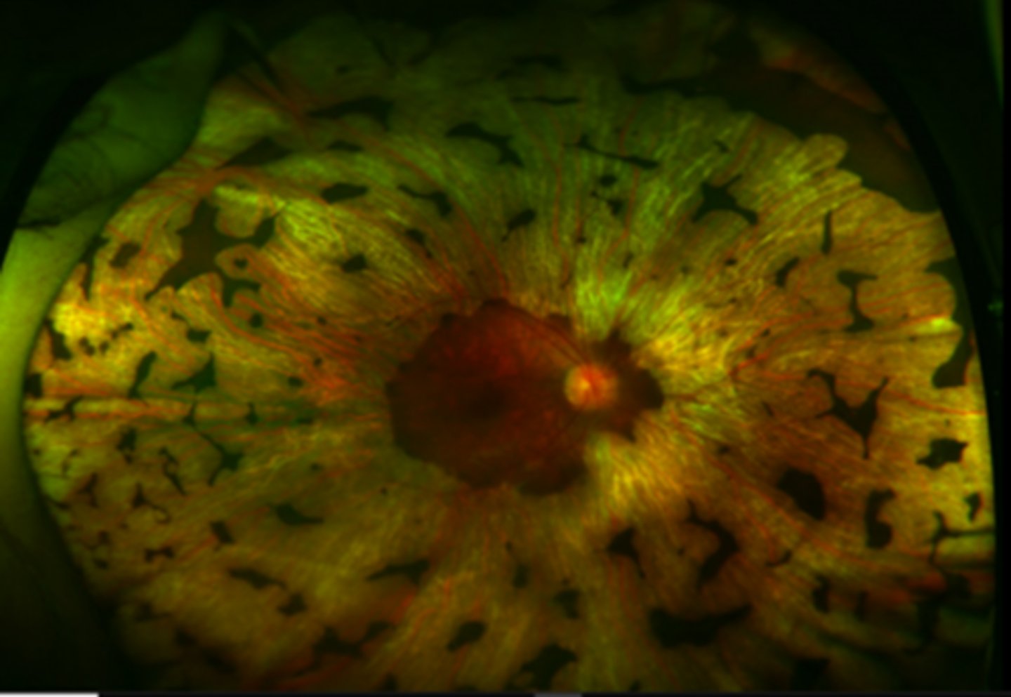 <p>What is the evolution of <strong>gyrate atrophy</strong>?</p>