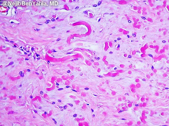<p>Masse subscapulaire femme de 40 ans&nbsp;</p><p>1) Diagnostic&nbsp;</p><p>2) Epidemio (type de patient, localisation)</p><p>3) Histologie&nbsp;</p><p>4) DD&nbsp;</p>