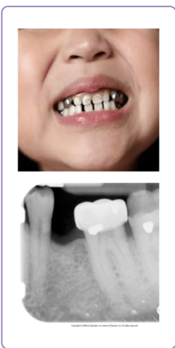 <p>- Prefabricated metal crowns usually seen in children</p><p>- Radiopaque but not as dense as an amalgam or gold</p><p>- &gt; Sometimes may be able to see thru to tooth</p>