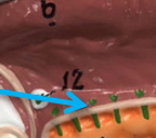 <p>Several small ducts that carry saliva from the sublingual gland directly into the floor of the mouth.</p>