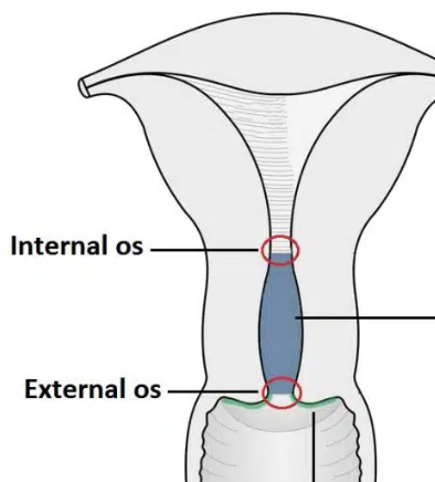 <ul><li><p>“os” = opening</p></li><li><p><span style="color: yellow;">junction of cervical canal and vaginal canal</span> (cervix to vagina)</p></li><li><p>“constricts <span style="color: yellow;">lower end of cervix</span>”</p></li></ul><p></p>