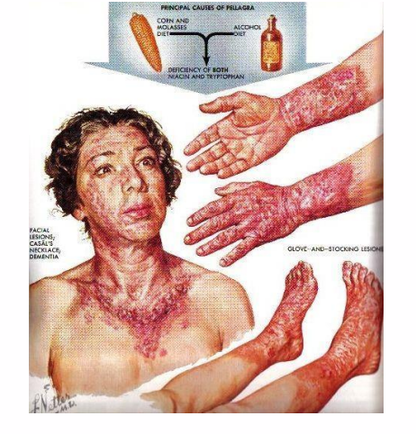 <p>Niacin (Vitamin B3) Deficiency: Pellagra</p>
