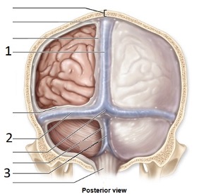 <p>Meningeal extension Number 1</p><p></p>