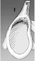 <p>Type 1 SLAP Lesion </p>