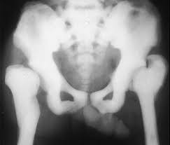 <p>It is a rare hereditary bone dysplasia in which failure of the resorptive mechanism of calcified cartilage interferes with the normal \n replacement by mature bone. results in very brittle bones. Increase in exposure factors required.</p>