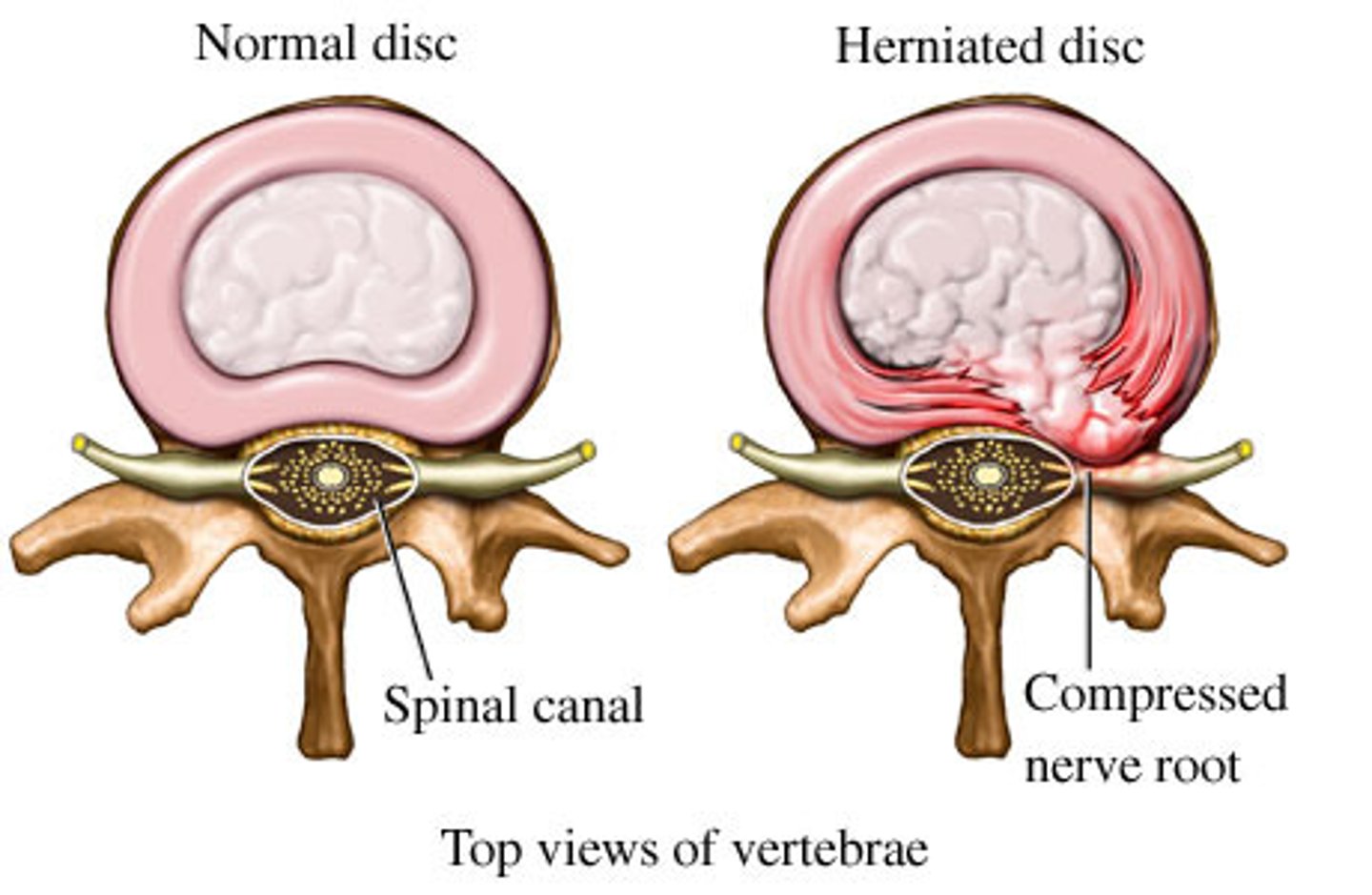<p>herniated disc</p>