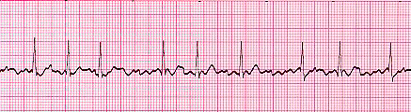 <p>Atria is quivering but not contracting, AV node acts as a filter to protect the ventricle</p>