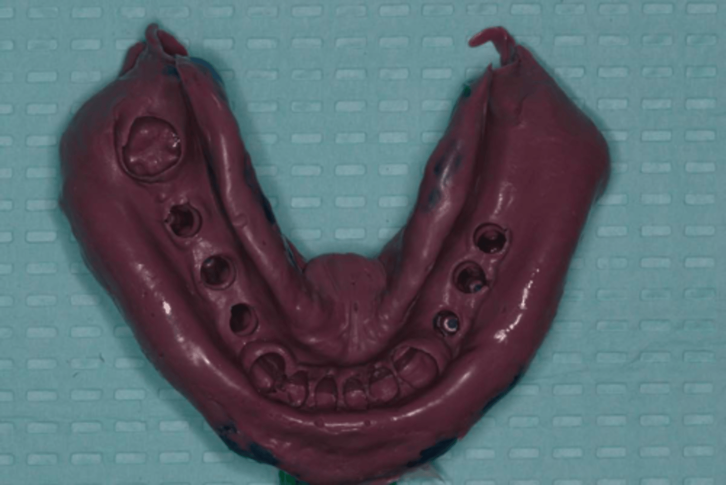 <p>ID the technique:</p><ul><li><p>after obtaining pa or bitewing radiograph to verify fit of impression copings</p></li><li><p>prepare tray for impression (apply adhesive) - there is no need to “open” the tray</p></li></ul><p></p>