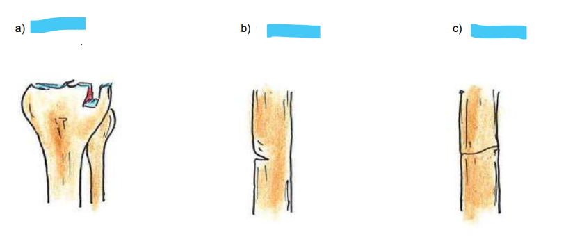 <p>Knochenbruchformen</p>