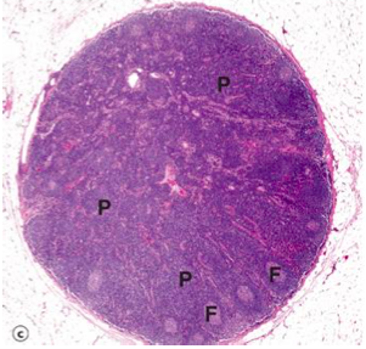 <p>enlarged tissue on outside bc of active T cell response</p>