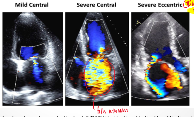 <p>travels along atrial wall&nbsp;</p>
