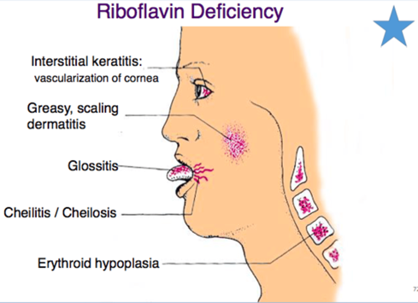 <p>1) Cheilosis - cracking of mouth</p><p>2) Angular stomatitis - painful sores at the corners of the mouth</p><p>3) Glossitis - inflammation of the tongue</p><p>4) Magenta tongue - specific to Ariboflavinosis</p><p>5) Photophobia & Corneal vascularization</p>