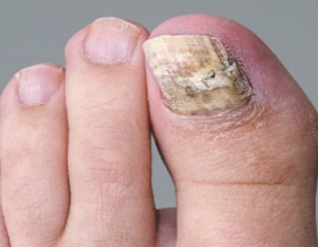 <p>Fungal infection of the nail; nail root is infected and the nail is deformed as it grows.</p>