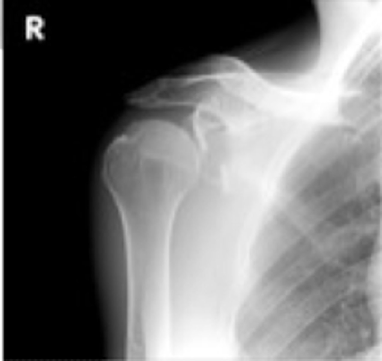 <p>glenoid labrum tear in the anterior joint that occurs due to an ANTERIOR dislocation most commonly</p>