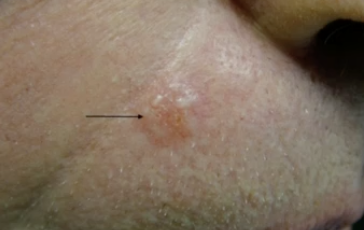 <p>Which demographic do you see basal cell carcinoma (BCC) in?</p>