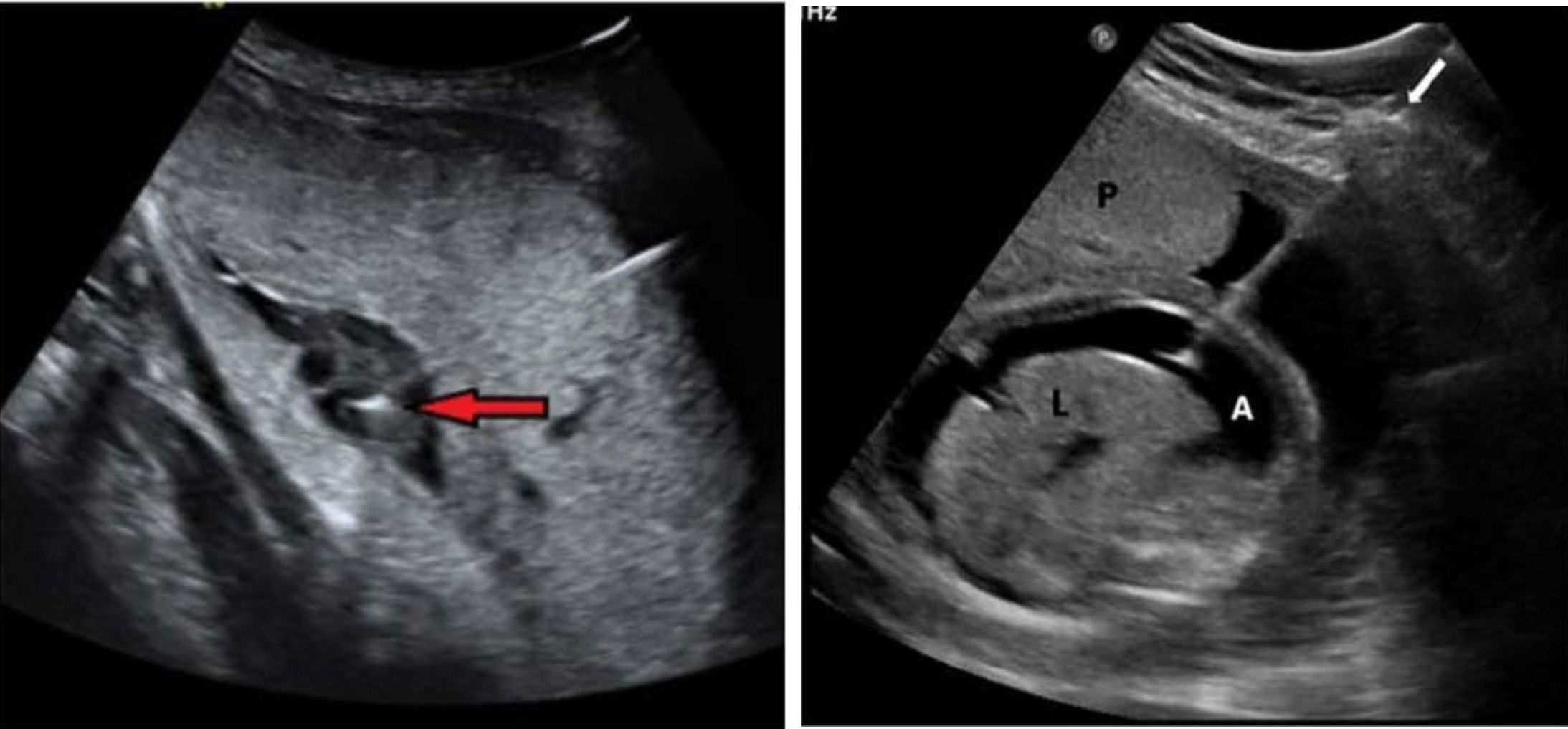 <p>Which image is intravascular and which is intraperitoneal transfusion?</p>