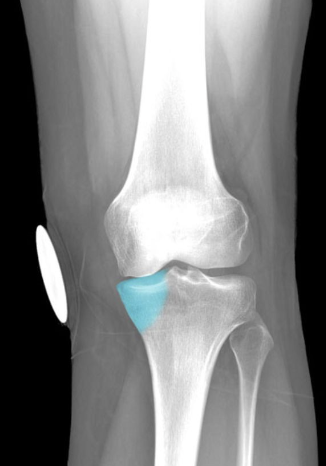 Function:
Provides attachment for
semimembranosus muscle and tibial
(medial) collateral ligament