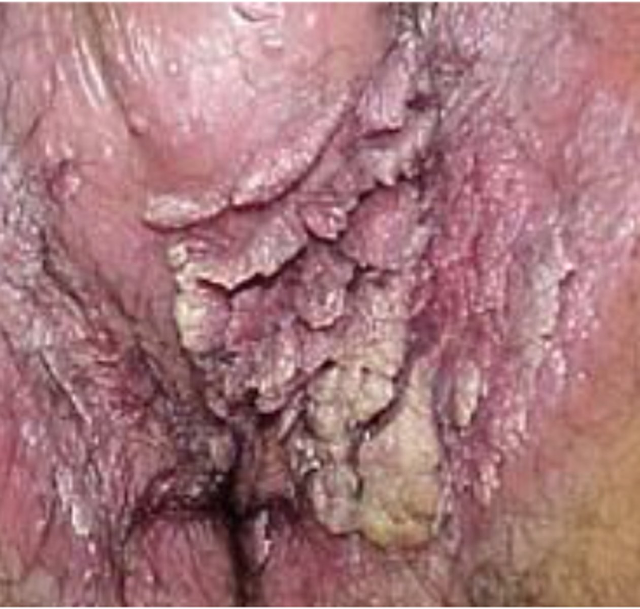 <p>infection of genital or anal skin by HPV, lesions spread rapidly over moist areas as well as symmetric surfaces of the labia or rectum</p>