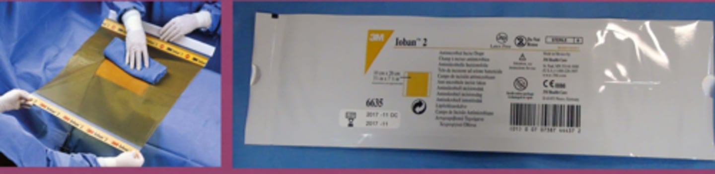 <p>Ioban is an adhesive, iodine -impregnated wound or surgery site cover that slowly releases iodine onto the skin and provides continuous broad spectrum antimicrobial activity. It can provide a sterile working field surrounding a surgical site or it can be used as a tertiary layer.</p><p>To assure adherence to the skin, an additional adhesive is applied to skin first. Dont leave in place for a long time or it will be hard to get off.</p>