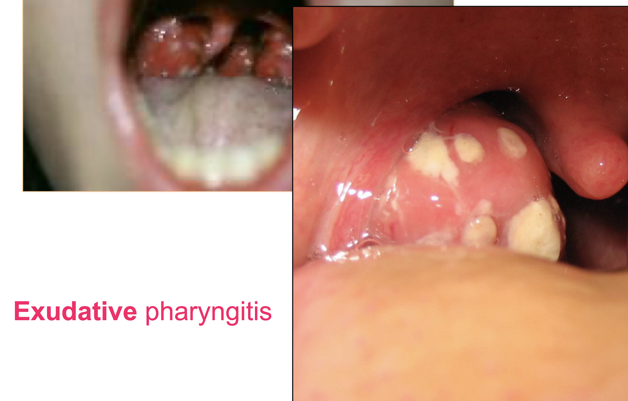 <p><strong>• Acute pharyngitis / tonsillitis -</strong> most common cause GAS can lead to severe exudative tonsillitis</p><p><strong>• Scarlet fever</strong></p><p><strong>• Impetigo, </strong><span style="color: red;"><strong>erysipelas </strong></span><strong>(very red skin), cellulitis, sepsis in burns,</strong></p><p><strong>necrotising fasciitis</strong></p><p>•<strong> Toxic Shock Syndrome</strong></p>