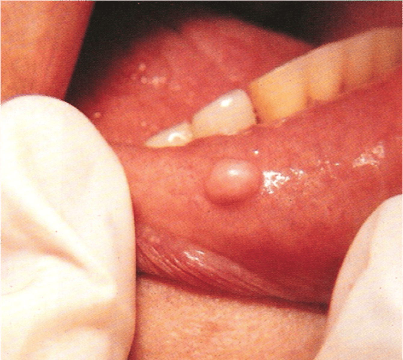 <p>Sessile</p>