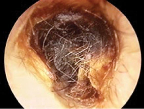 <p>Do you think this is an example of cerumen impaction or a fungal infection? </p>