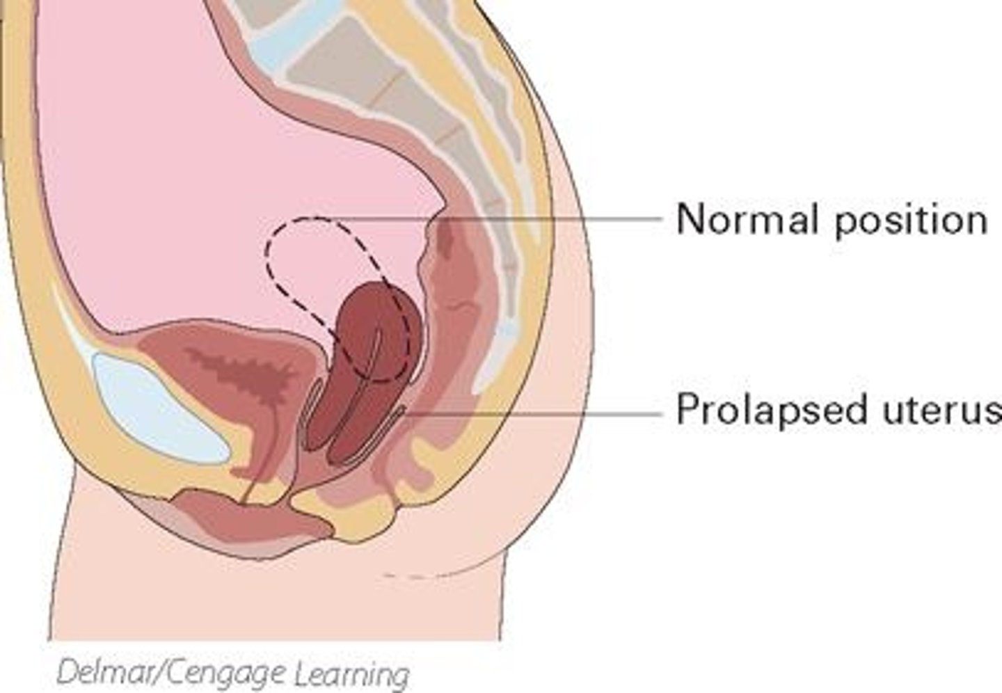 <p>prolapsed uterus</p>