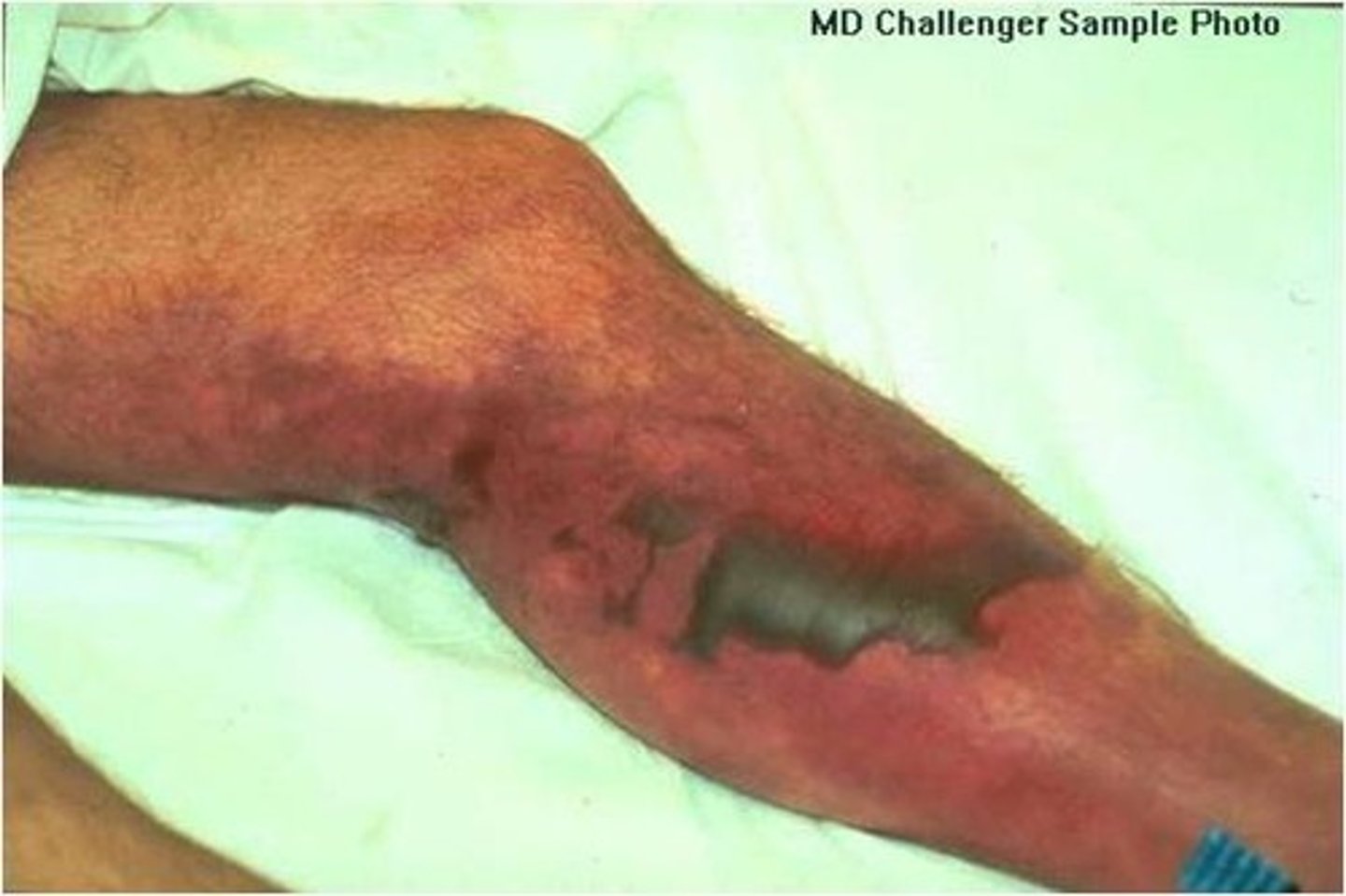 <p>CA: Group A Strep - Staphylococcus areus<br>MOT: -not contagious -bact. exposure<br>Si/Sx: -small, painful, red lumps/bumps that spread<br>-bruise area w/ dark center -F/C -decreased BP<br>Dx: -Biopsies (tissue samples) -bloodwork -CT/MRI scan<br>Tx: -surgery (debridement) -IV ABX</p>