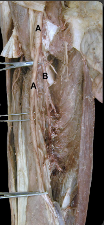 <p>“A” turns into what artery after passing through the adductor hiatus </p>