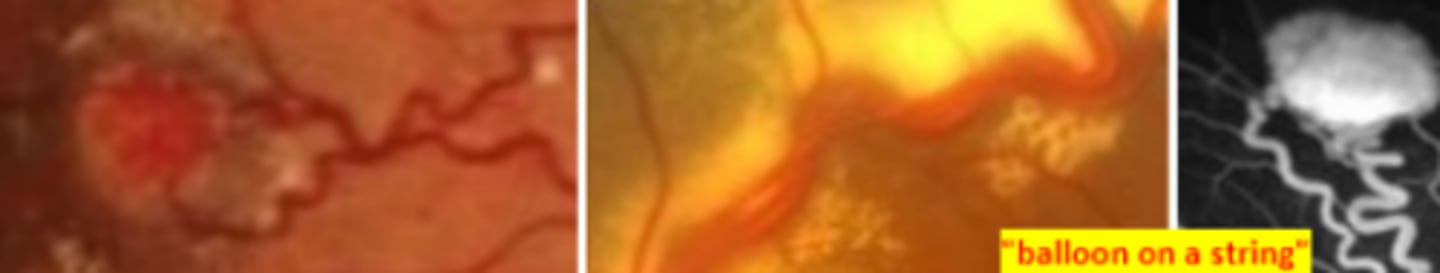 <p>rare vascular tumors of the retina or ONH seen within 2 decades of life. Are sight threatening as these vessels tend to leak. Is associated with Von Hippel Lindau syndrome especially when multiple lesions are present. Risk of macular edema and retinal detachment (exudates) as well as neovascularization (ischemia). Refer for systemic work-up and treatment of retinal complications.</p>