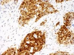 <p>What does strong brown nuclear staining in a p53 IHC indicate?</p>