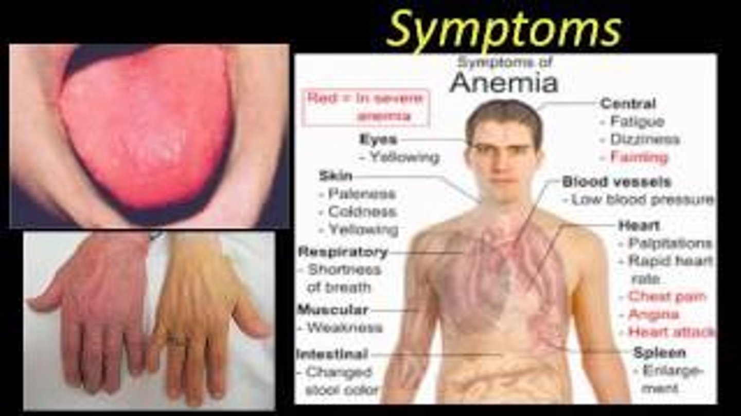 <p>Examine the tongue</p><p>The tongue is smooth and beefy red in the client with vitamin B12 deficiency, so examining the tongue should be included in the physical assessment.</p>
