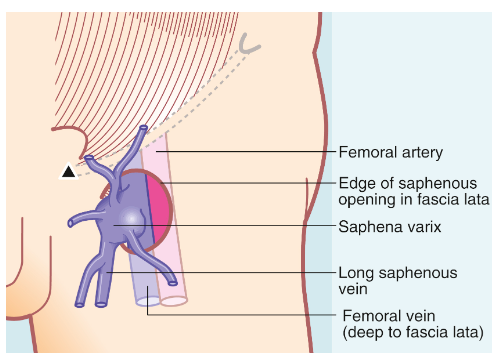 * = a dilatation of the long saphenous vein in the groin just proximal to its junction with the femoral vein
* caused by vascular incompetence at that point
* there are usually substantial varicose veins elsewhere in the long saphenous system
* swelling is soft and diffuse
* ==__diagnostic feature__== → empties with minimal pressure and refills on release
* cough impulse is invariably present and a fluid thrill can be felt if varicosities further down the thigh are tapped lightly
* treatment → high saphenous ligation, as for saphenofemoral reflux associated with varicose veins 