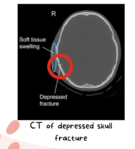 <ul><li><p><strong>Non-depressed fracture</strong>s: close observation for signs of brain injury.</p><ul><li><p>Discharge education for family.</p></li></ul></li><li><p><strong>Depressed fractures</strong>:<em> requires surgery with elevation of skull and debridement.</em></p><ul><li><p>Consequential injuries from fracture (scalp laceration, dural tears, lacerations from bony fragments, etc.)</p></li></ul></li><li><p><strong>Patient/Family Education on Prevention</strong>:</p><ul><li><p>Always wear helmets when skateboarding, riding a bike, motorcycle, skiing, playing football, etc.</p></li><li><p>Wear your seatbelt and use approved car seats/booster seats.</p></li><li><p>Avoid dangerous activities</p></li><li><p>Firearm safety</p></li><li><p>Avoid riding in the back of a pick-up truck</p></li><li><p>Fall prevention at home</p><ul><li><p>How can you prevent falls in the inpatient setting?</p><ul><li><p>bed alarms, grip socks, bed at a lower setting, call light near patient, hourly rounding, etc.</p></li></ul></li></ul></li></ul></li></ul><p></p>