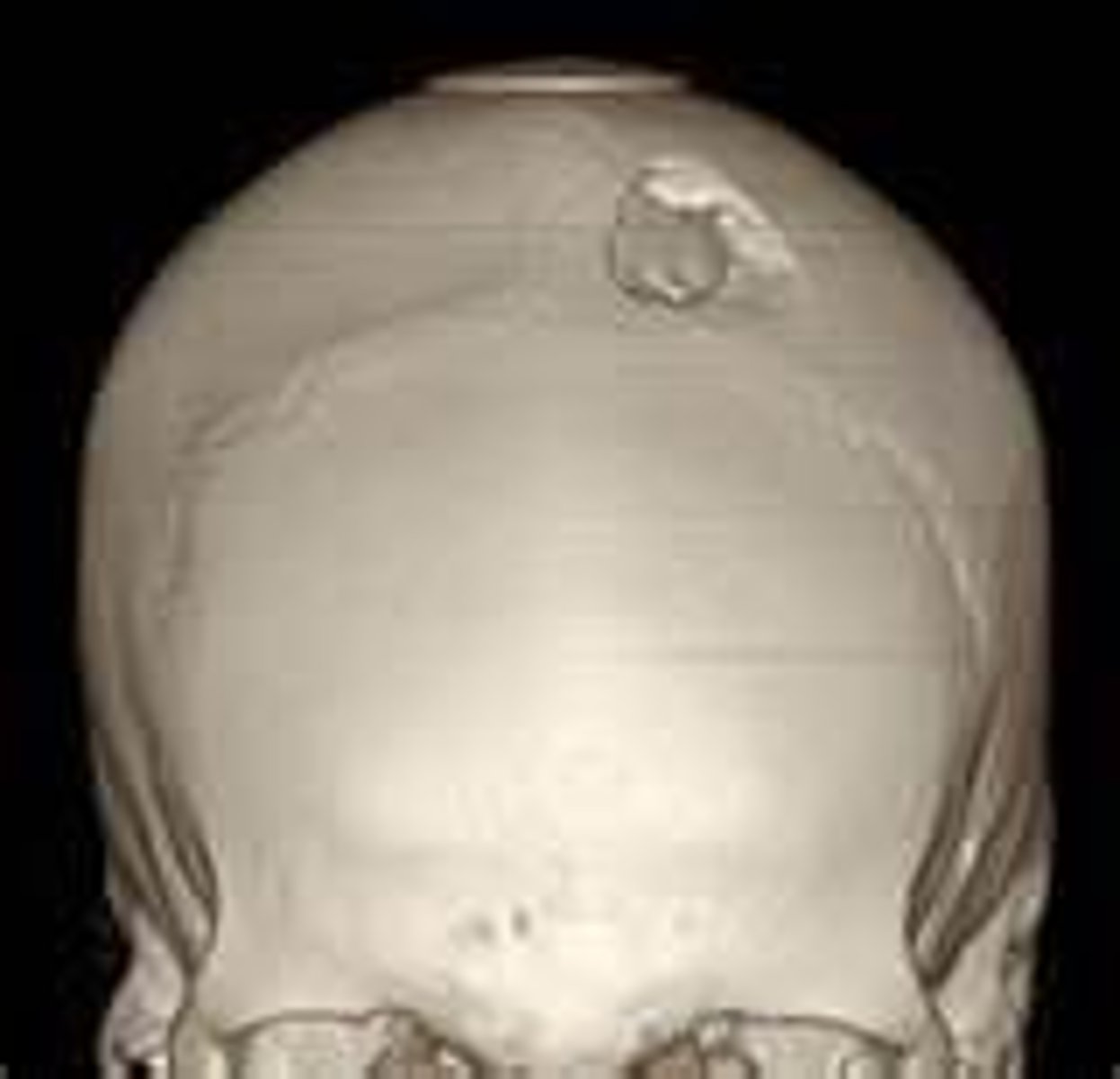 <p>may cause indentations and bony fragments to enter the brain cavity</p>