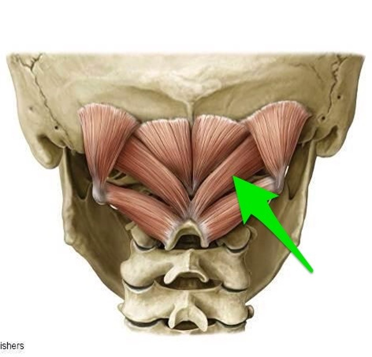 <p>head extension and ipsilateral rotation</p><p>O: bifid processes of C2</p><p>I: inferior nuchal line of occipital</p><p>N: suboccipital nerve (dorsal ramus of C1)</p>
