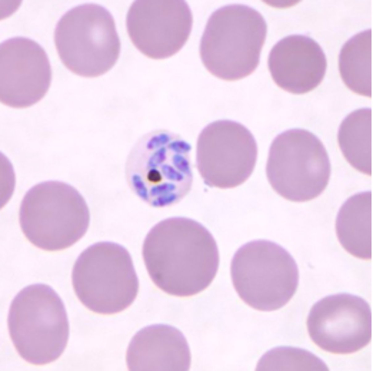 <p>(2) malarial parasite</p><p>ring form: resembles P. falciparum (TWO chromatin dots with APPLIQUE forms)</p><p>trophozoite: BAND-shaped</p><p>schizont: DISTORTED and FIMBRIATED RBCs; GRAPE-like; NO rosettes</p><p>gametocytes: round or oval</p>