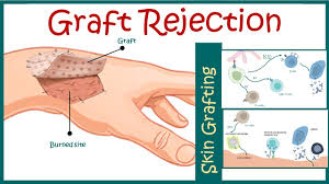 <p>Failure of graft (transplanted organ) to survive in recipient</p>